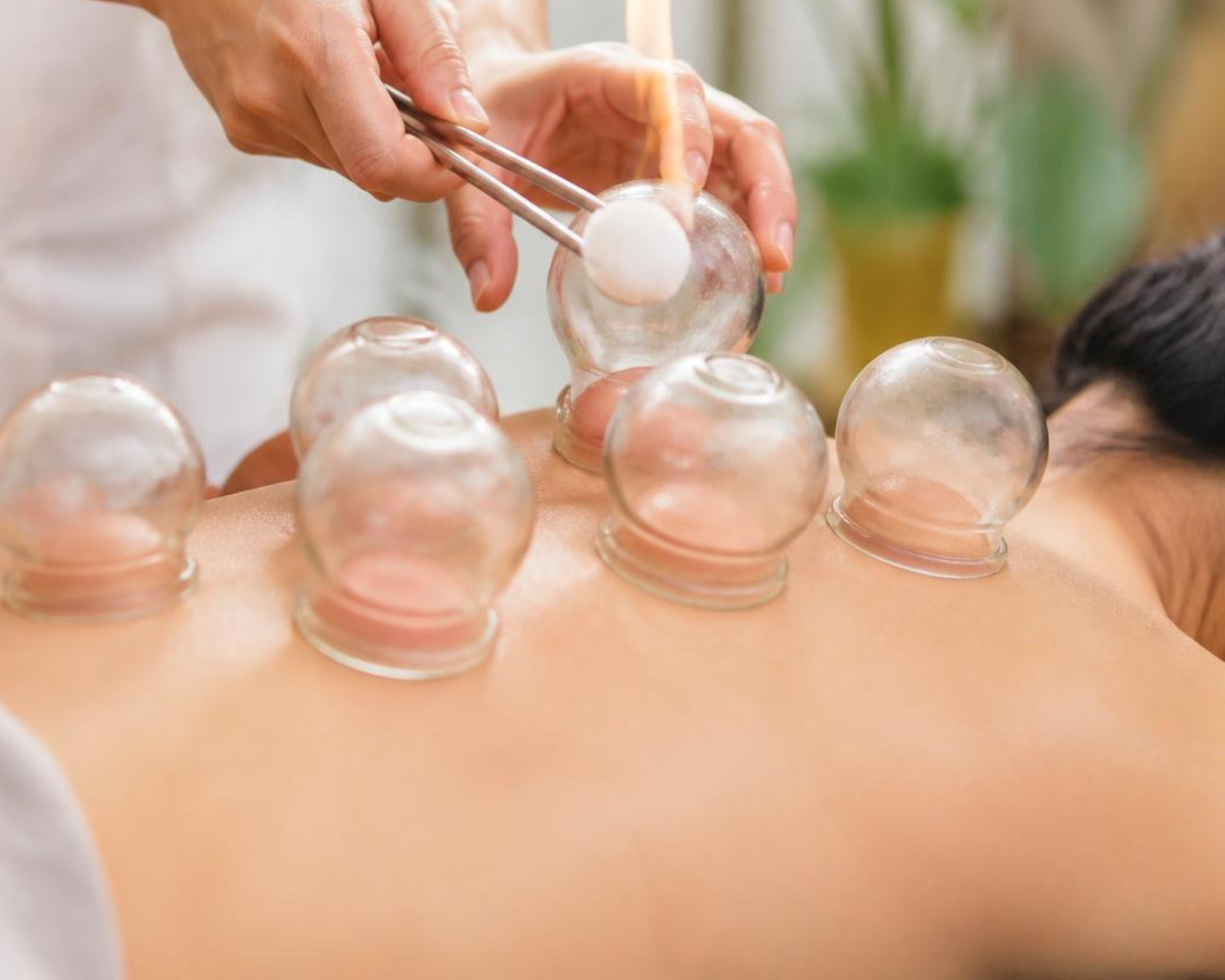 Traditional Chinese Cupping Therapy