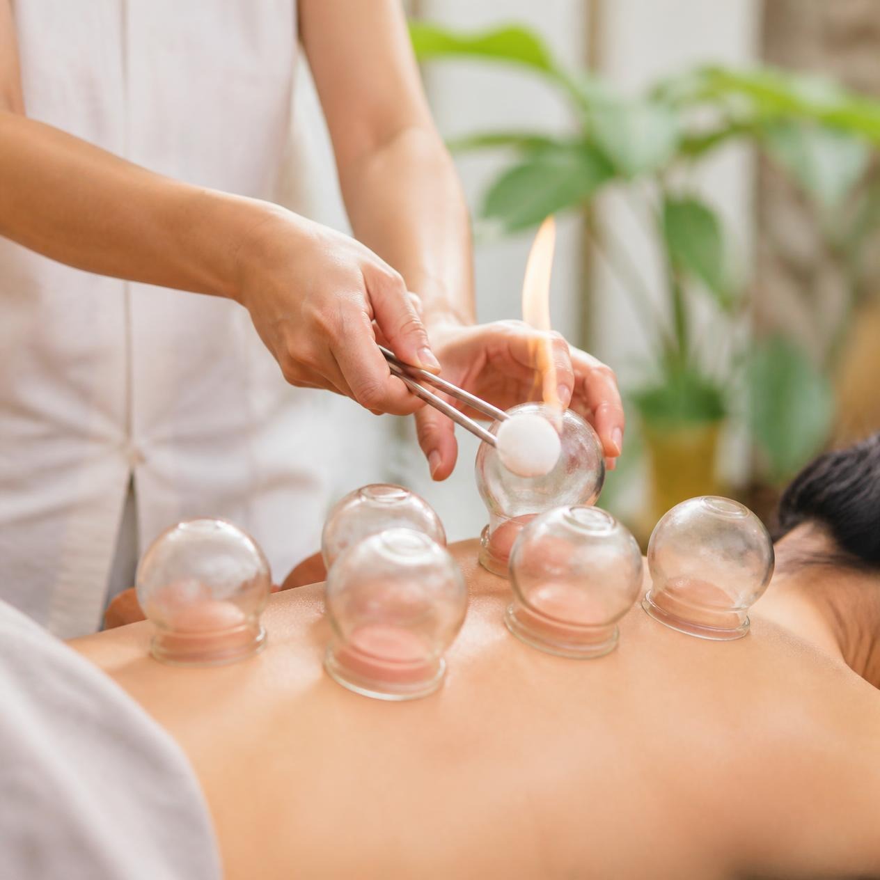 Traditional Chinese Cupping